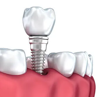 Single-tooth dental implant