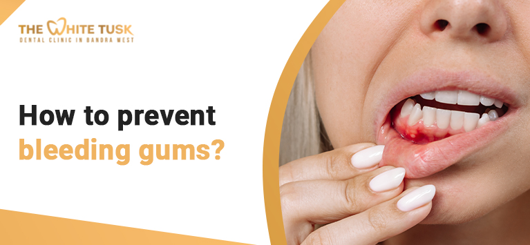 How to prevent bleeding gums?