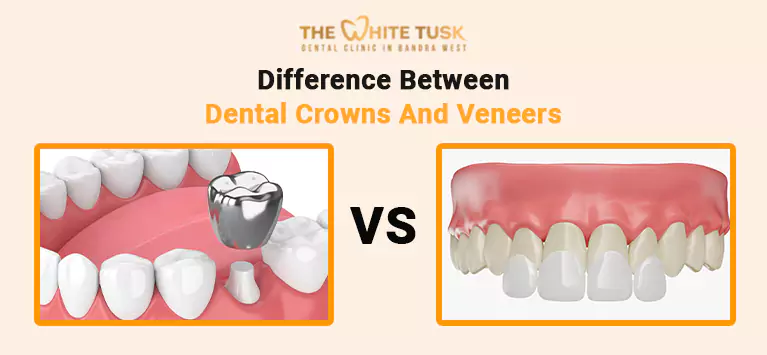 Difference between dental crowns and veneers