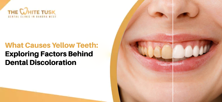 What- Causes -Yellow- Teeth-: Exploring- Factors- Behind -Dental -Discoloration