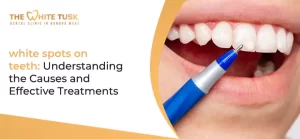 white -spots -on -teeth: -Understanding -the -Causes -and -Effective -Treatments