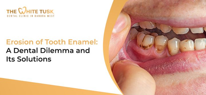 Erosion -of -Tooth -Enamel: A- Dental- Dilemma -and -Its Solutions