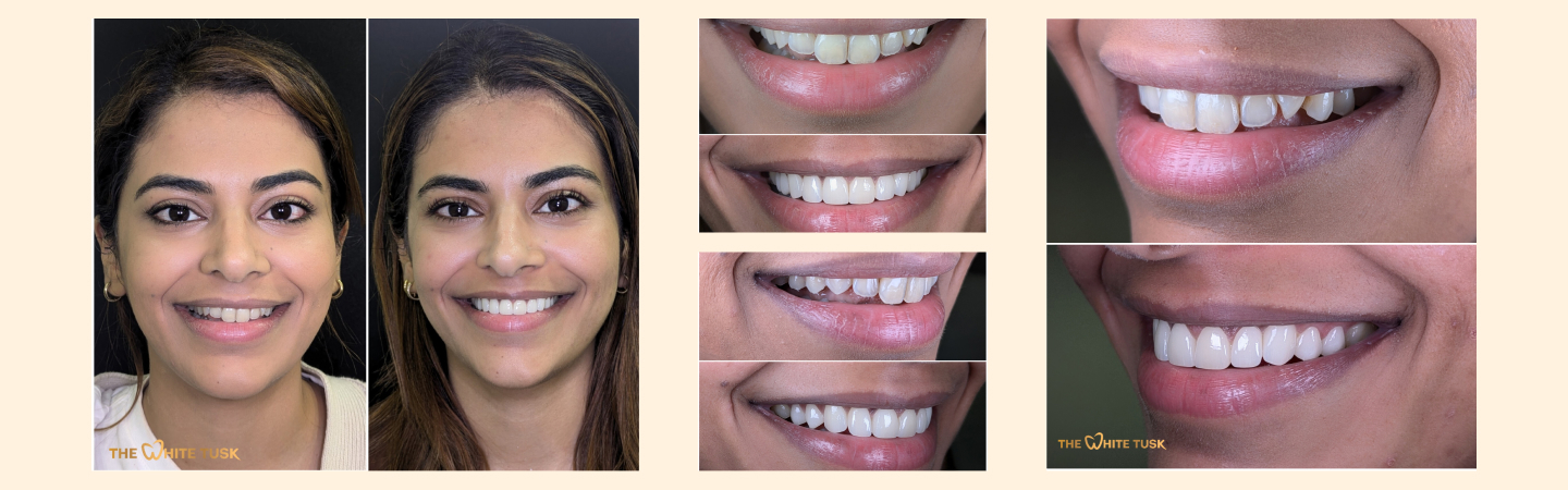 Dental Veneers