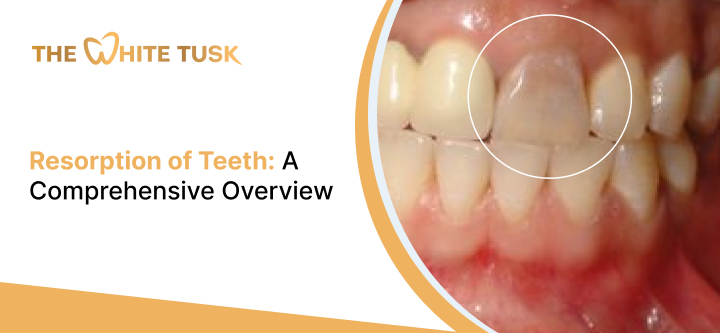 Resorption of Teeth