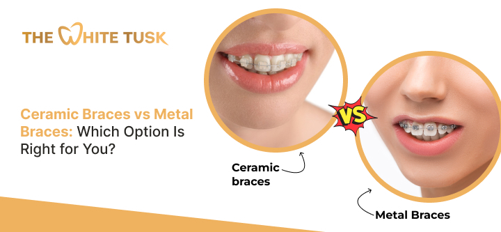 Ceramic Braces vs Metal Braces: Which Option Is Right for You?