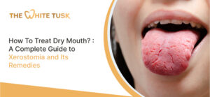 How To Treat Dry Mouth? : A Complete Guide to Xerostomia and Its Remedies