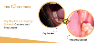 Dry Socket vs Healthy Socket: Causes and Treatment