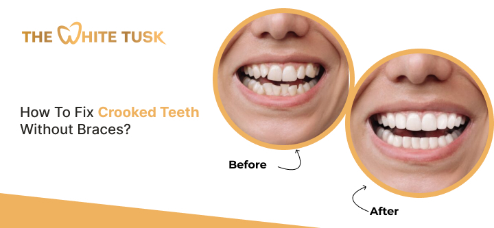 How To Fix Crooked Teeth Without Braces?